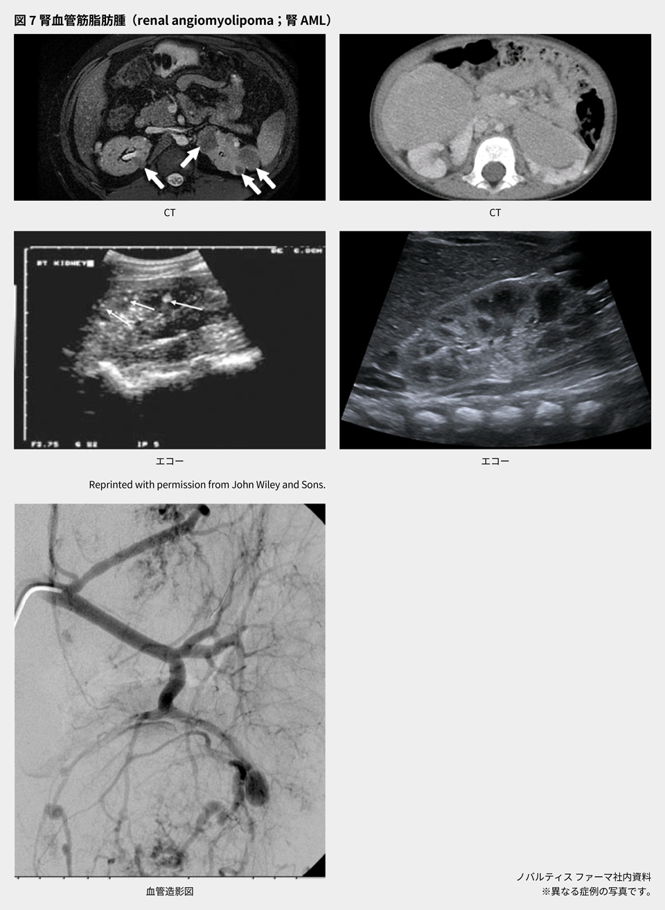 afinitor_tsc_symptom_07_pc.png afinitor_tsc_symptom_07_pc.png