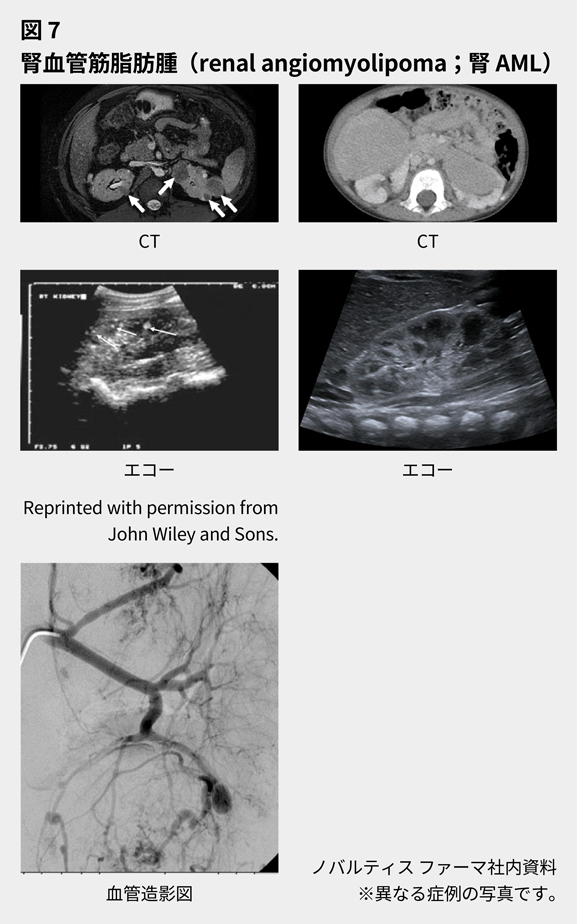 afinitor_tsc_symptom_07_sp.png afinitor_tsc_symptom_07_sp.png