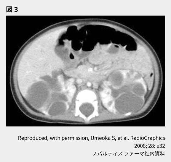 afinitor_tsc_symptom_08_01_sp.png afinitor_tsc_symptom_08_01_sp.png