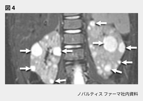 afinitor_tsc_symptom_08_02_sp.png afinitor_tsc_symptom_08_02_sp.png