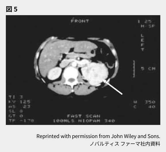 afinitor_tsc_symptom_08_03_sp.png afinitor_tsc_symptom_08_03_sp.png