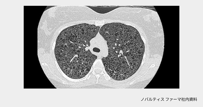 afinitor_tsc_symptom_09_pc.png afinitor_tsc_symptom_09_pc.png