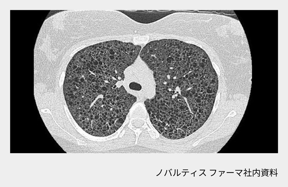 afinitor_tsc_symptom_09_sp.png afinitor_tsc_symptom_09_sp.png