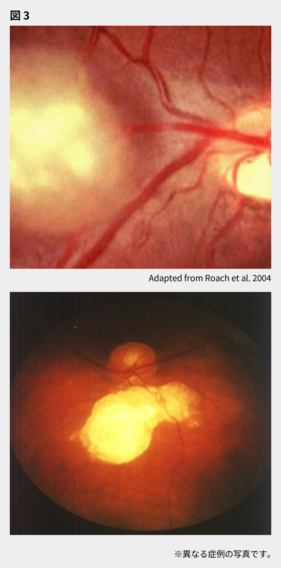 afinitor_tsc_symptom_10_sp.png afinitor_tsc_symptom_10_sp.png