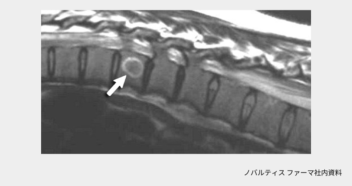 afinitor_tsc_symptom_11_01_pc.png afinitor_tsc_symptom_11_01_pc.png