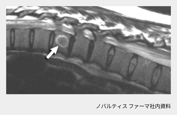 afinitor_tsc_symptom_11_01_sp.png afinitor_tsc_symptom_11_01_sp.png