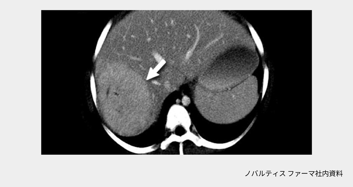 afinitor_tsc_symptom_11_02_pc.png afinitor_tsc_symptom_11_02_pc.png
