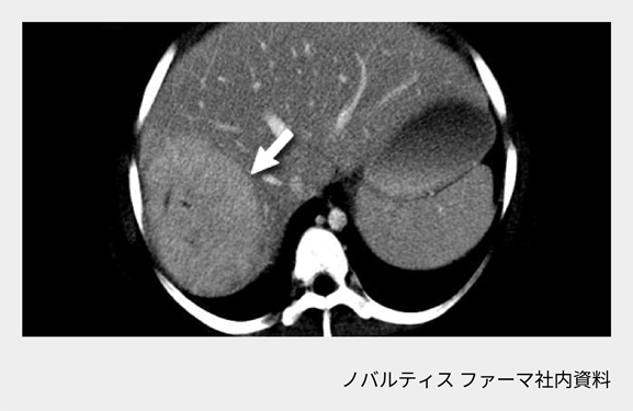 afinitor_tsc_symptom_11_02_sp.png afinitor_tsc_symptom_11_02_sp.png