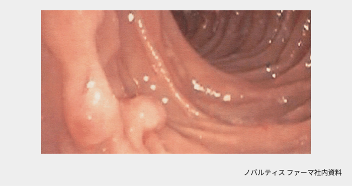 afinitor_tsc_symptom_11_03_pc.png afinitor_tsc_symptom_11_03_pc.png