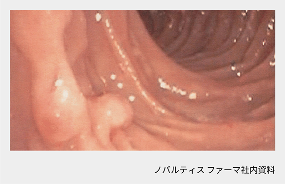 afinitor_tsc_symptom_11_03_sp.png afinitor_tsc_symptom_11_03_sp.png