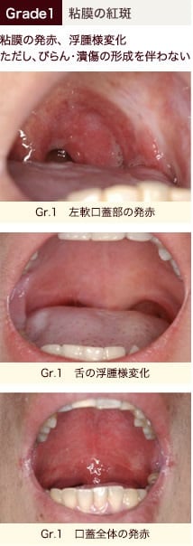 stomatitis_05.jpg stomatitis_05.jpg