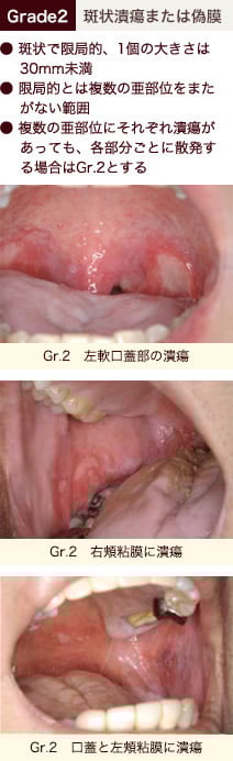 stomatitis_06.jpg stomatitis_06.jpg