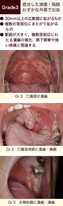 stomatitis_07.jpg stomatitis_07.jpg