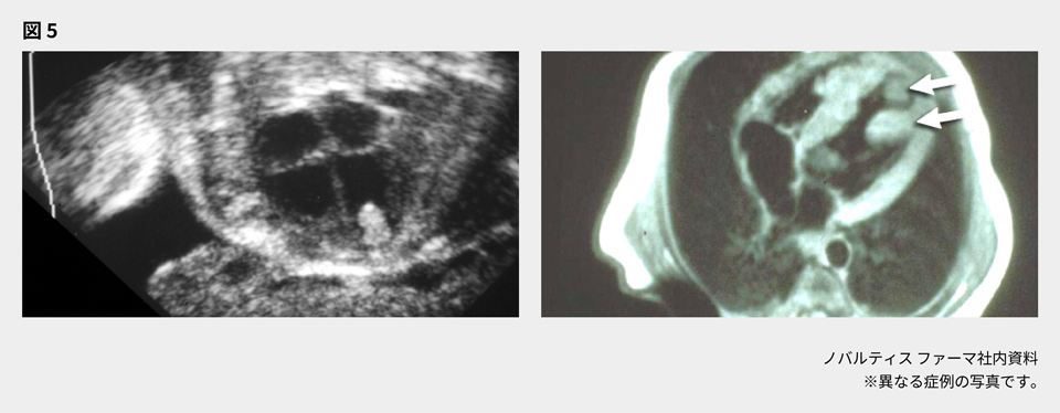 afinitor_tsc_symptom_02_pc.png afinitor_tsc_symptom_02_pc.png