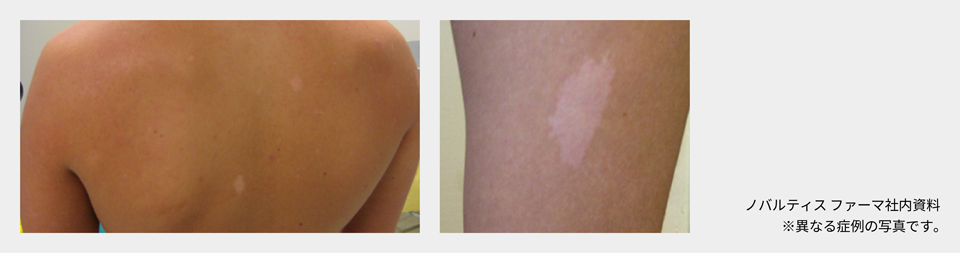 afinitor_tsc_symptom_06_01_pc.png afinitor_tsc_symptom_06_01_pc.png