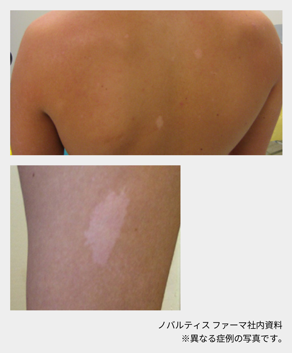 afinitor_tsc_symptom_06_01_sp.png afinitor_tsc_symptom_06_01_sp.png