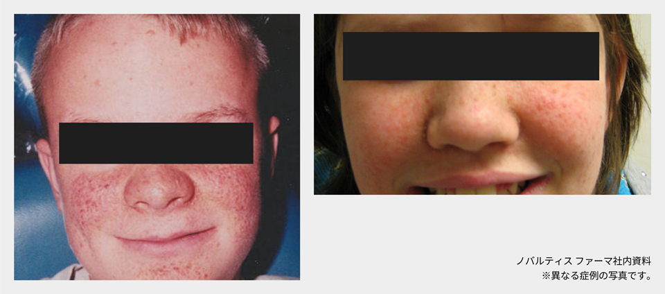 afinitor_tsc_symptom_06_02_pc.png afinitor_tsc_symptom_06_02_pc.png