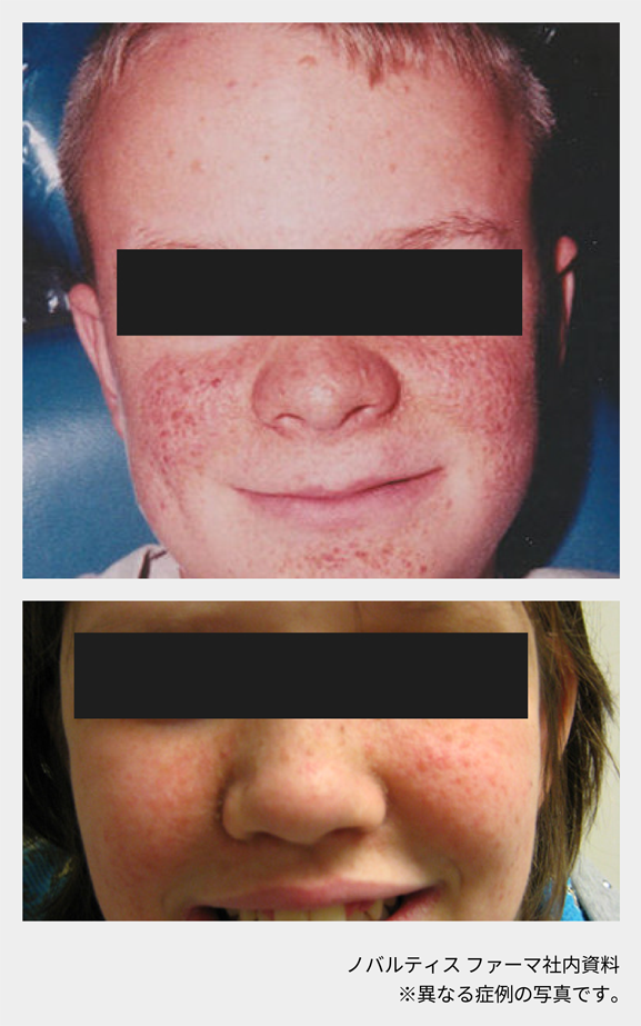 afinitor_tsc_symptom_06_02_sp.png afinitor_tsc_symptom_06_02_sp.png
