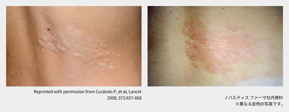 afinitor_tsc_symptom_06_03_pc.png afinitor_tsc_symptom_06_03_pc.png