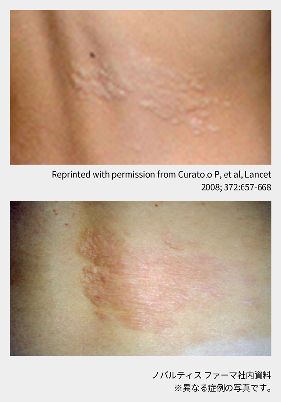 afinitor_tsc_symptom_06_03_sp.png afinitor_tsc_symptom_06_03_sp.png