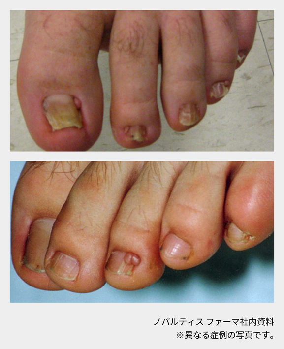 afinitor_tsc_symptom_06_04_sp.png afinitor_tsc_symptom_06_04_sp.png