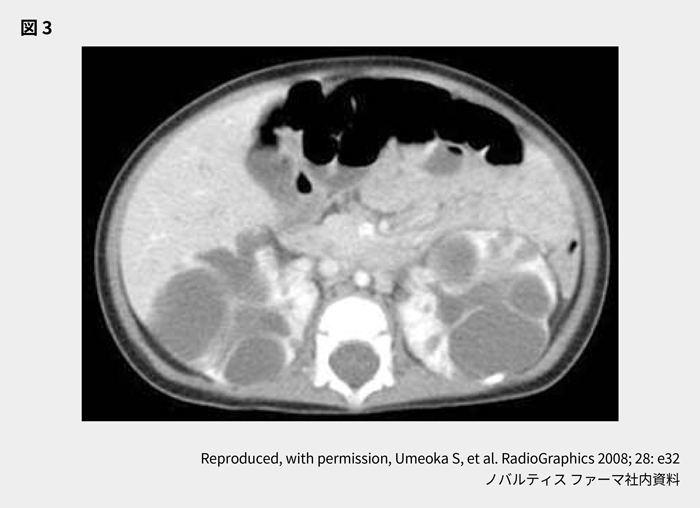 afinitor_tsc_symptom_08_01_pc.png afinitor_tsc_symptom_08_01_pc.png