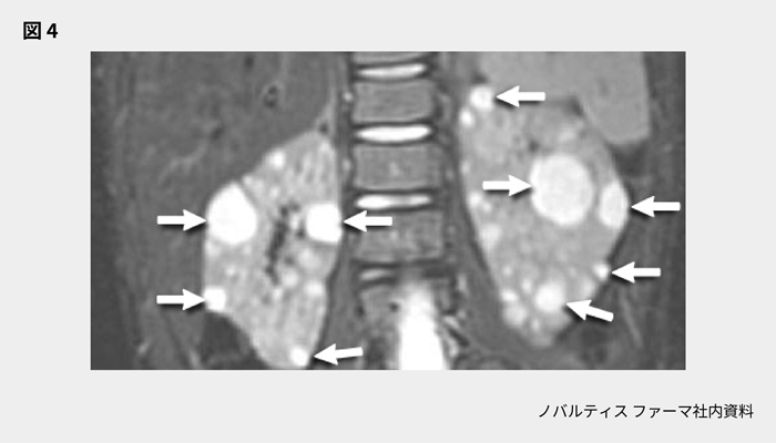 afinitor_tsc_symptom_08_02_pc.png afinitor_tsc_symptom_08_02_pc.png