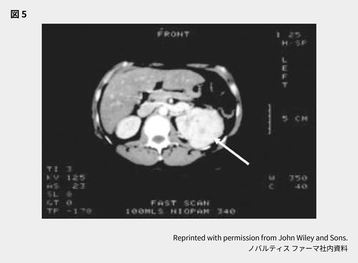 afinitor_tsc_symptom_08_03_pc.png afinitor_tsc_symptom_08_03_pc.png
